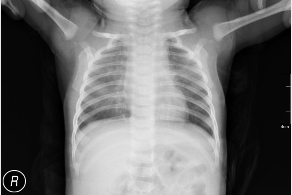 Nano-X Imaging Investors Face August 11 Lead Plaintiff Deadline